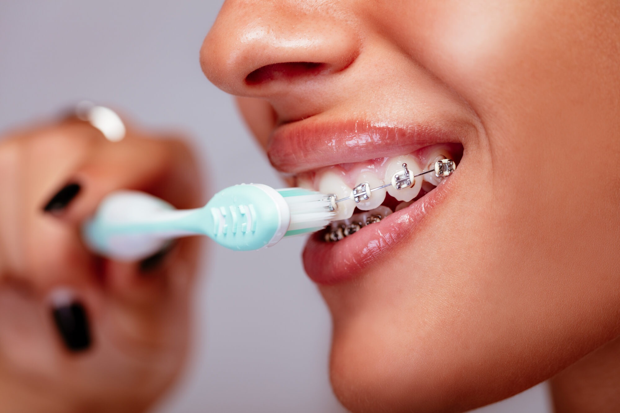 Top Tips for Brushing and Flossing With Braces