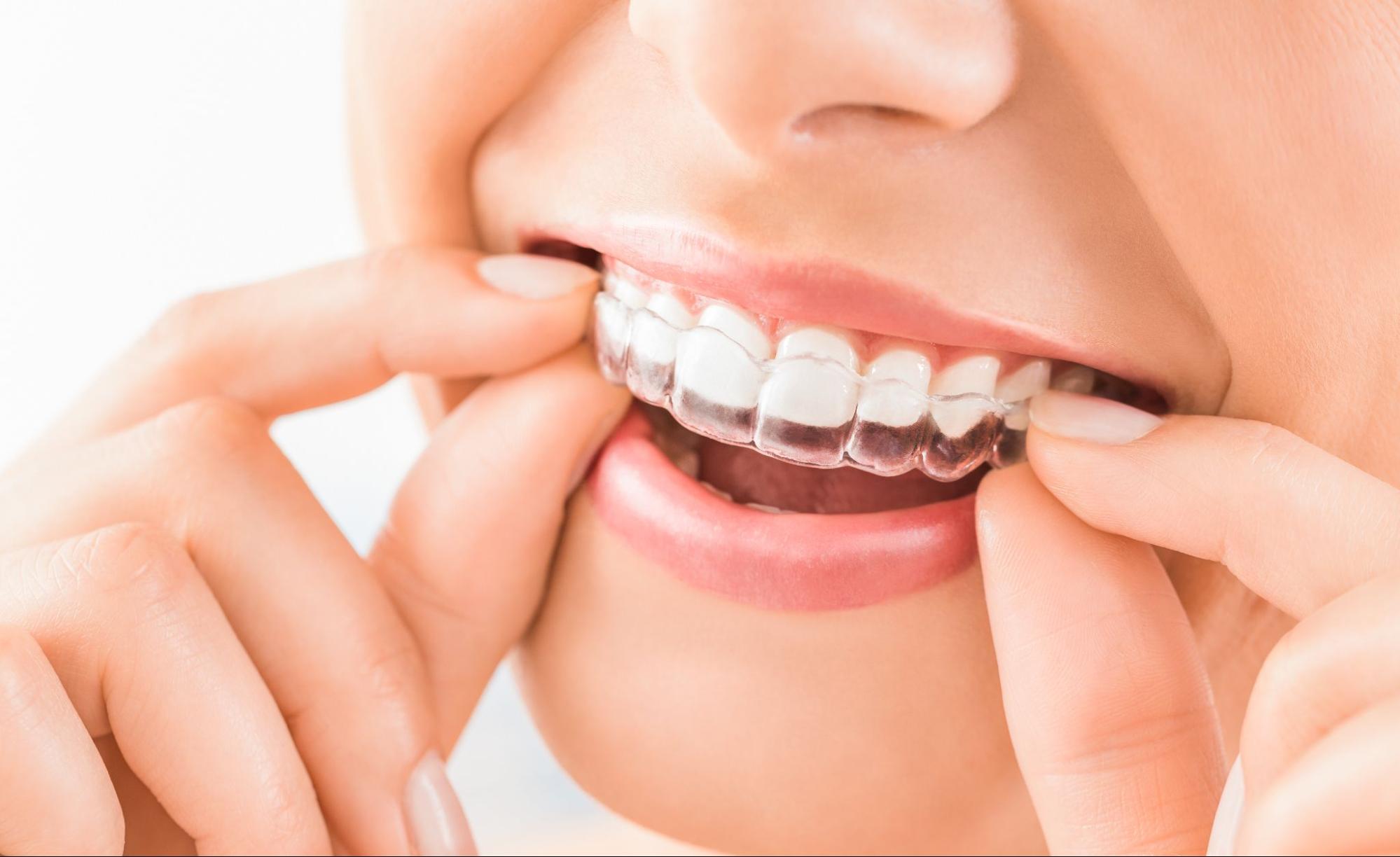 How Do You Monitor Progress While Using Invisalign?